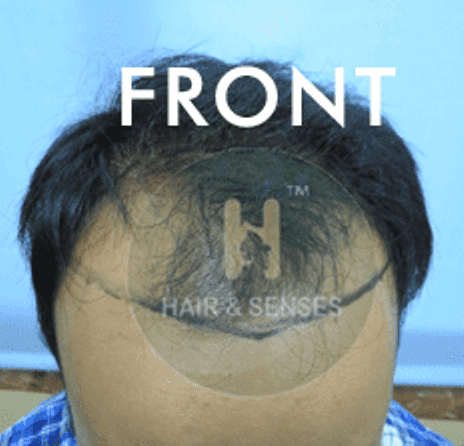 Hair Transplant Case Study